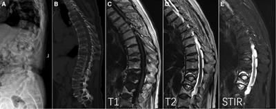 Kyphoplasty for thoracic and lumbar fractures with an intravertebral vacuum phenomenon in ankylosing spondylitis patients